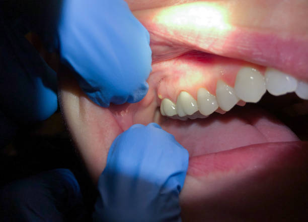 Best Emergency Treatment for Toothache in Palestine, TX